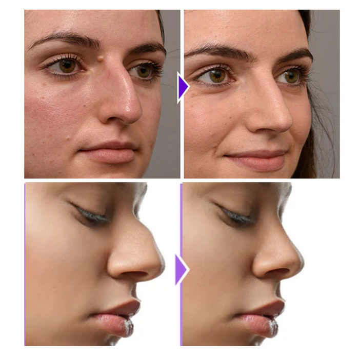 Nose Bridge Shaper - Hypoallergenic Silicone Device for Gradual Natural-Looking Results