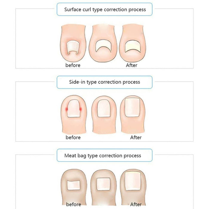Inlay nail corrector tool with strong adhesive tape