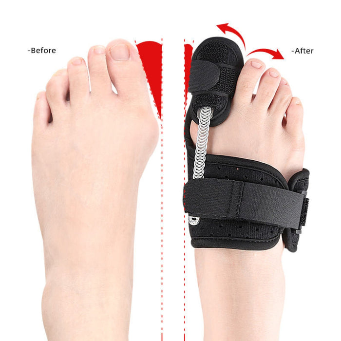 Infographic illustrating the "Before and After" effects of using the toe splint to correct hallux valgus and bunion deformities.