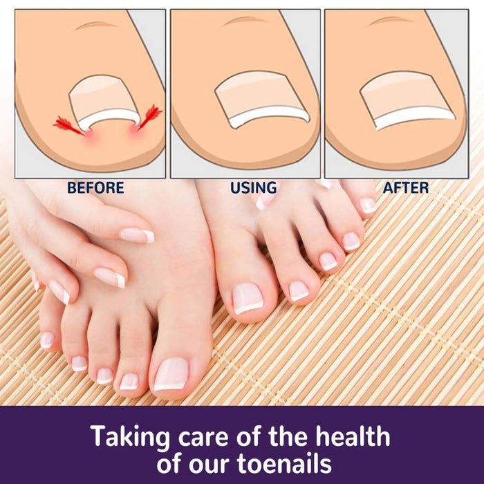 Digital Shoppy  Elastic Toenail Correction Patch ( 50 pcs )