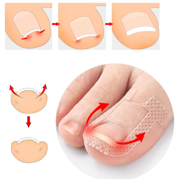 Digital Shoppy ingrown toenail correction illustration showing nail lifting process with adhesive strip
