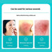 Three-panel infographic showing hydrocolloid dressing used for acne, abrasions, and burn care applications