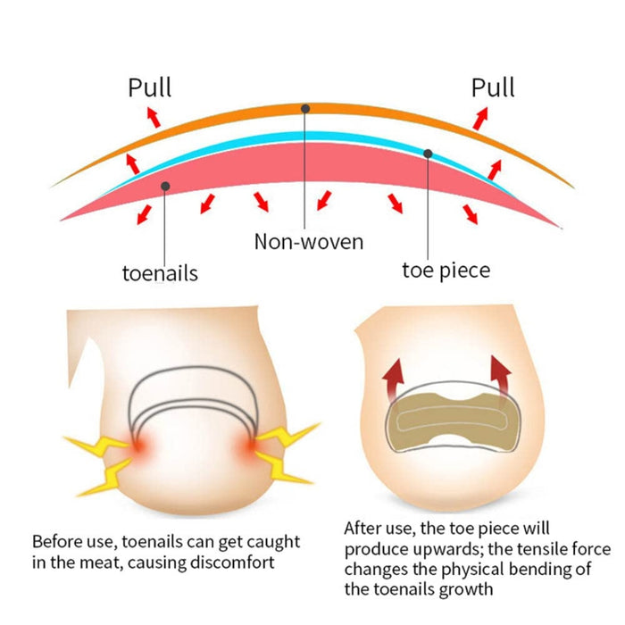 Nail inlay corrector tool with double-sided tape for secure and gentle application