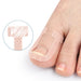  Digital Shoppy inverted T‑shaped adhesive bandage applied around toenail for ingrown nail protection