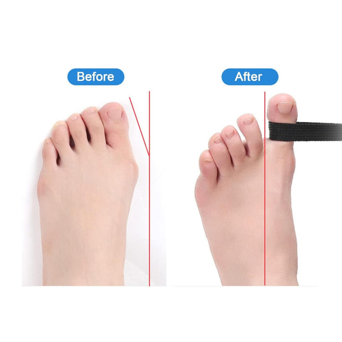 Before and after comparison illustrating the corrective effect of the tension band on hallux valgus alignment.