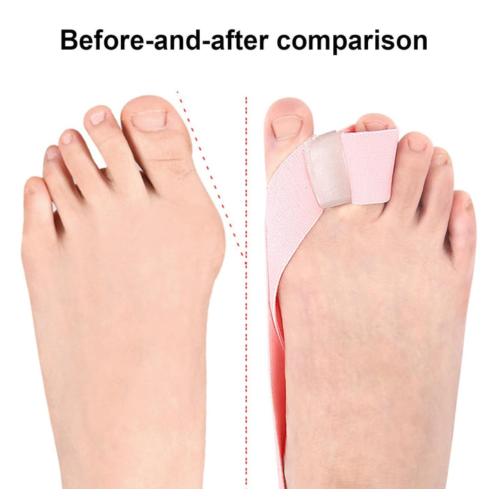 Digital Shoppy Big Toe Separator Bunion Splint Straightener With SEBS Toe Spacer Hallux Valgus Correction Foot Pain Relief Bunion Corrector