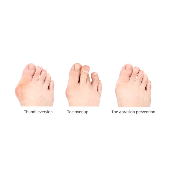 Digital Shoppy Toe Corrector for Hammer Toes, Overlapping Toes & Bunionette Pain ( 3 holes )