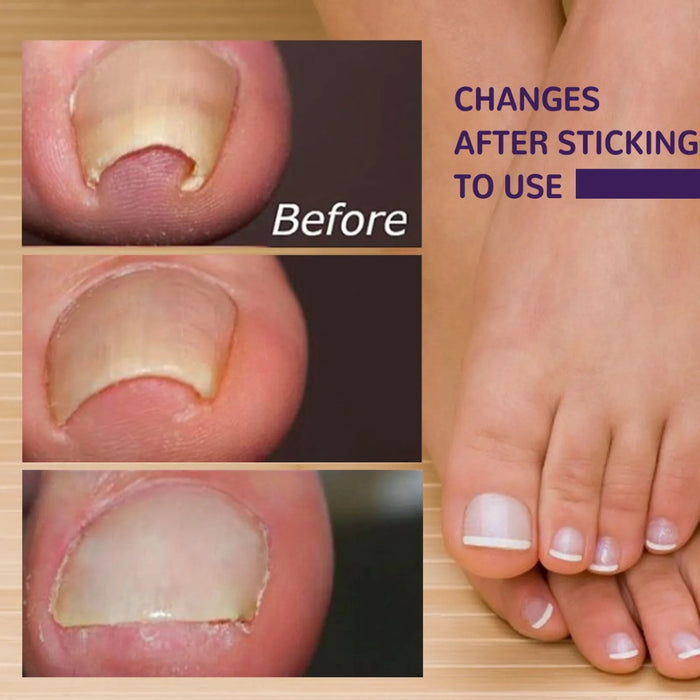 Digital Shoppy  Elastic Toenail Correction Patch ( 50 pcs )